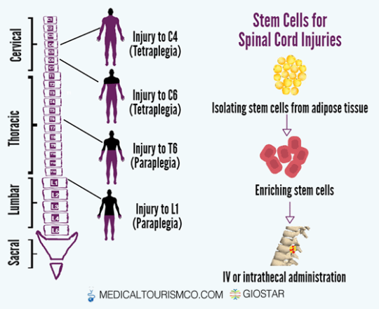 Spinal Injury Stem Cell Treatment In Mexico SCI Stem Cell Treatment GIOSTAR