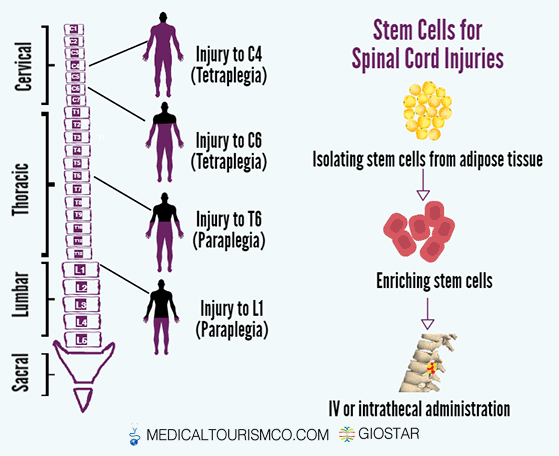 What's possible in spinal cord rehab today and stem cell therapy in the  future, Brain