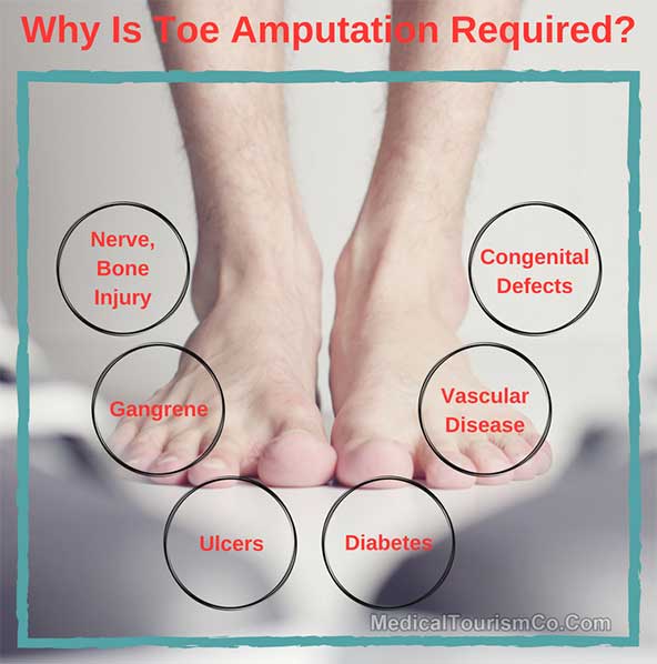 Toe amputation cpt
