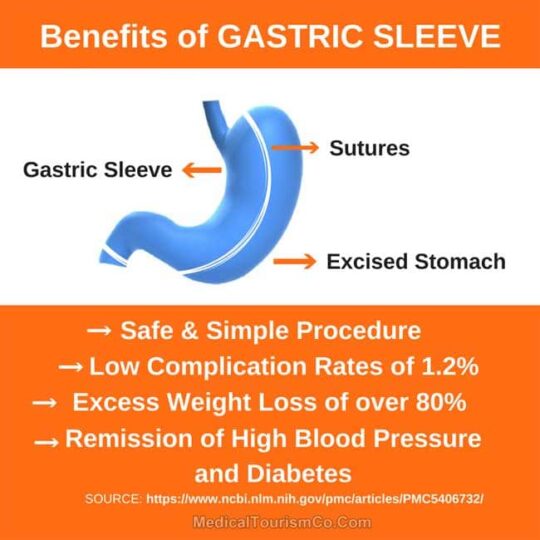 Benefits of Gastric Sleeve