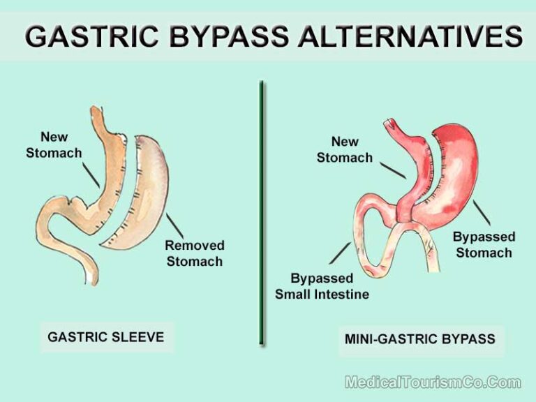 Gastric Bypass In Mexicali Mexico 8670