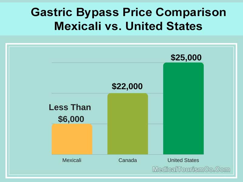 What Is The Average Cost Of Gastric Bypass Surgery