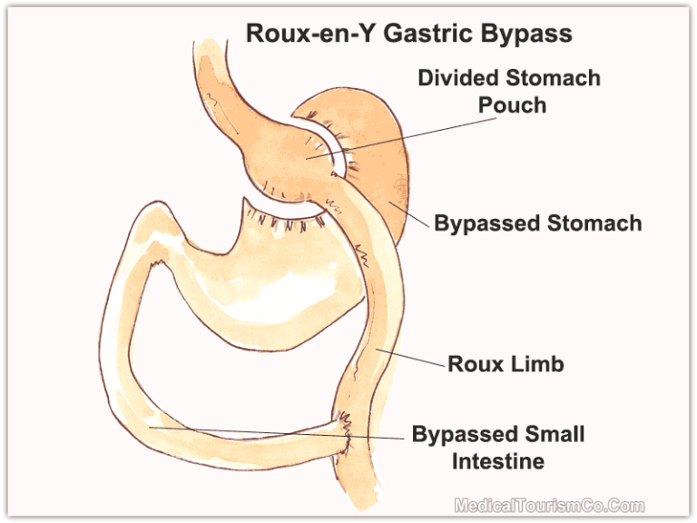 Mini Gastric Bypass Versus Gastric Bypass A Comparison