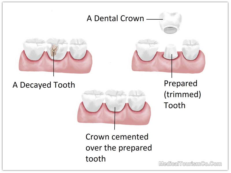 Dental Crowns In Costa Rica Best Cost Of Dental Caps In San Jose