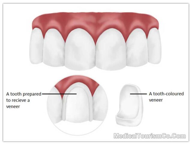 Porcelain Veneers in India | Cost & Quality Cosmetic Dentistry