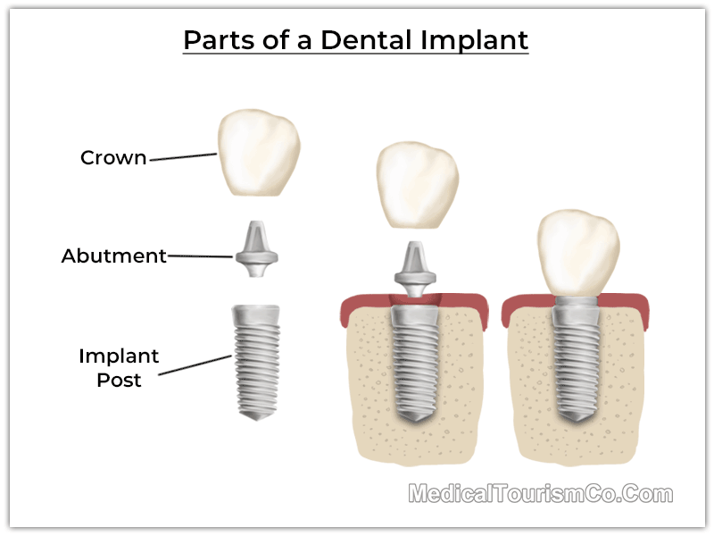 PartsofaDentalImplantcosta rica