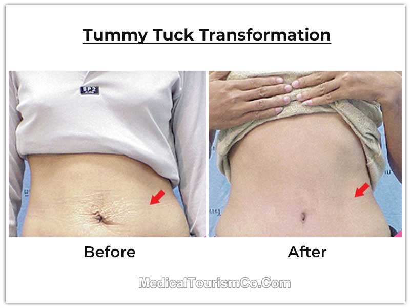 Mini Tummy Tuck Results- Dallas Mommy Makeover Surgeon- Dr. John