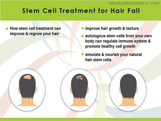 Stem Cells Therapy for Hair Loss | Affordable, Safe, Legal