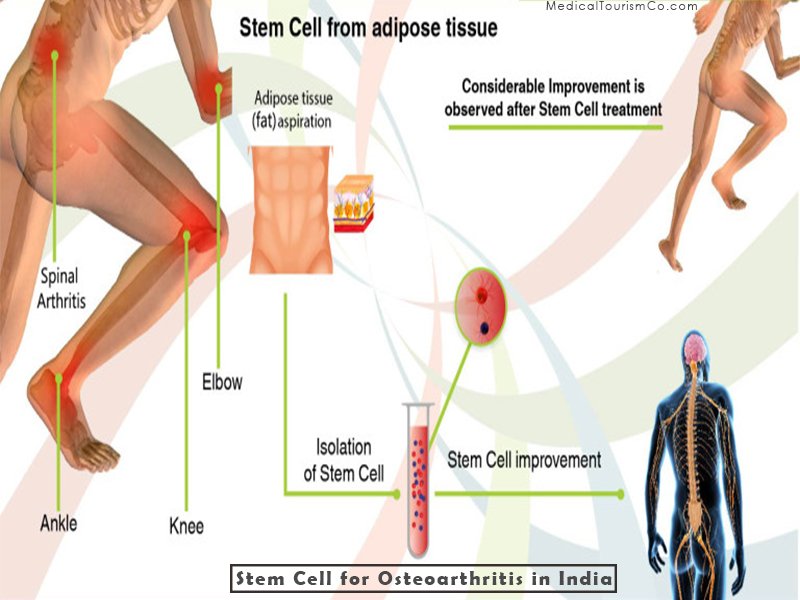 stem cell treatment for arthritis