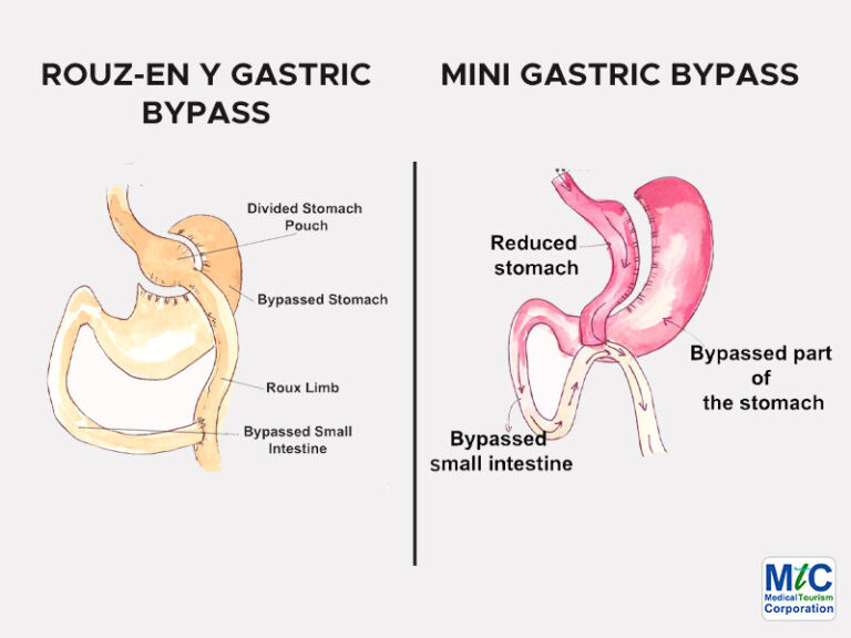 Mini Gastric Bypass In Nuevo Laredo Mexico Safe Bariatric Surgery 