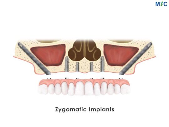 zygomatic-Implant