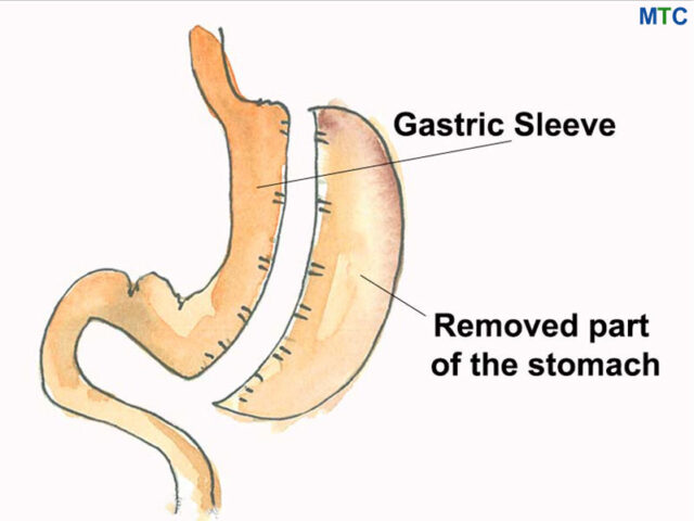 Gastric Sleeve in Mexico | Affordable & Safe | Top Hospitals