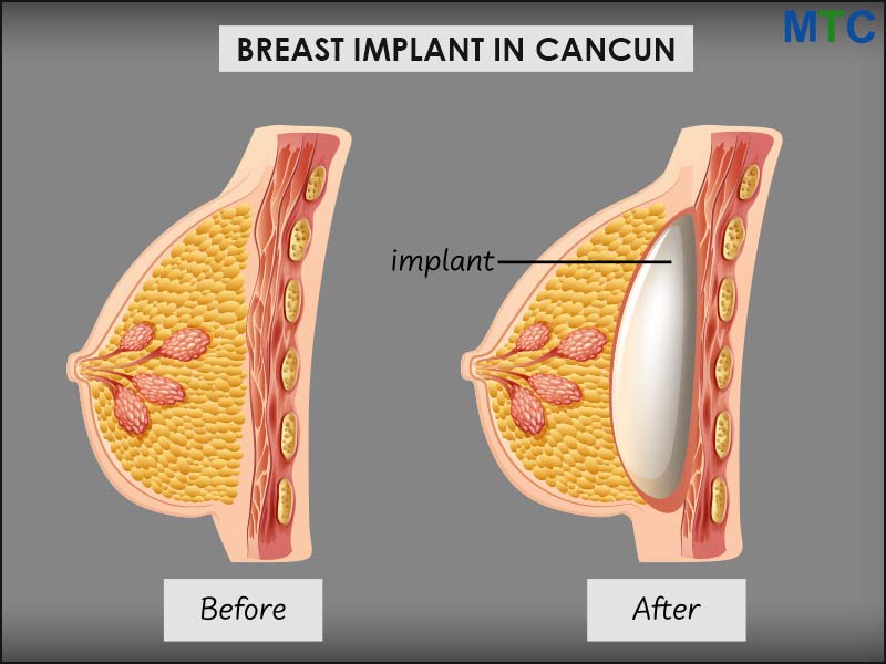 Breast Implants in Cancun  Best Price & Certified Surgeons