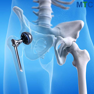 Hip replacement surgery in Lithuania | Cost, Surgeons & More