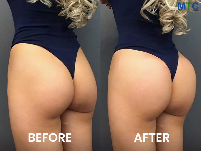Brazilian butt lift : Cost of BBL surgery in Istanbul, Turkey
