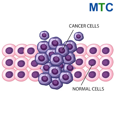 Stem Cell Therapy in Mexico | Affordable, Safe and Quality Treatment