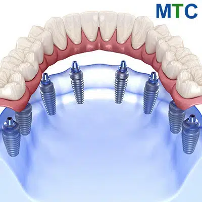 All-on-8 Implants