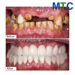 Before-After-dental-implants-in-Vietnam
