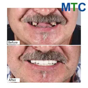 Before & After Dental Veneers in Vietnam