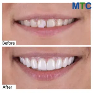Dental Veneers in Vietnam: Before & After