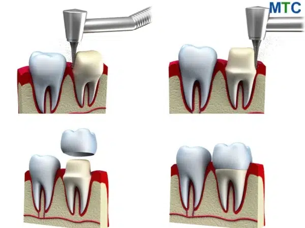 Dental Crown Procedure