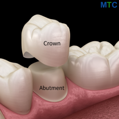 Dental Crowns