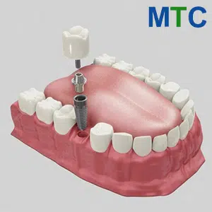 Single-Dental-Implant.jpg.webp