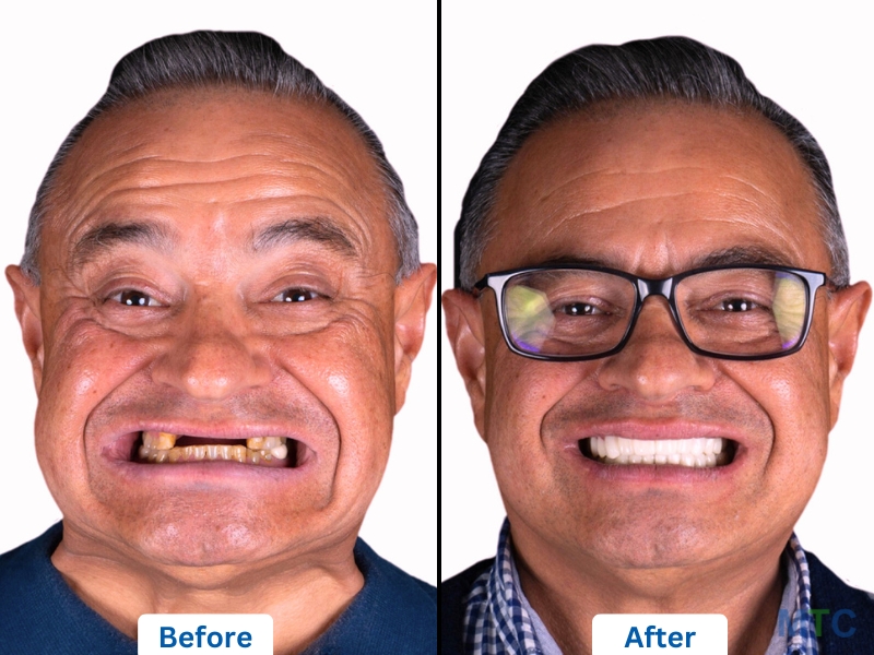 Full Mouth Dental Implants in Mexico placed by internationally trained dentists.