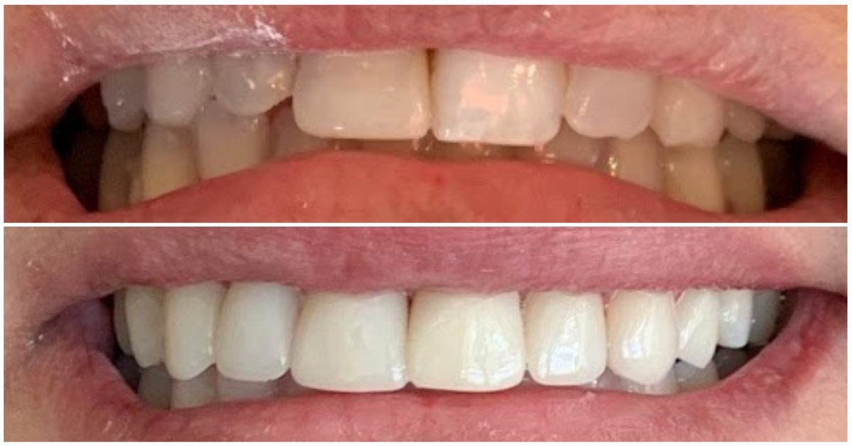 Veneers in Puerto Rico