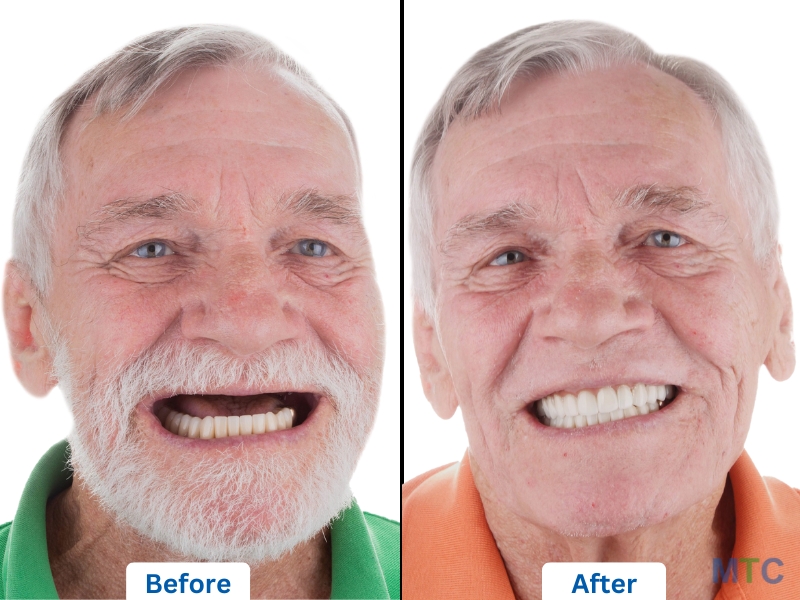 Affordable Upper Jaw Implants in Mexico by a certified dentist.