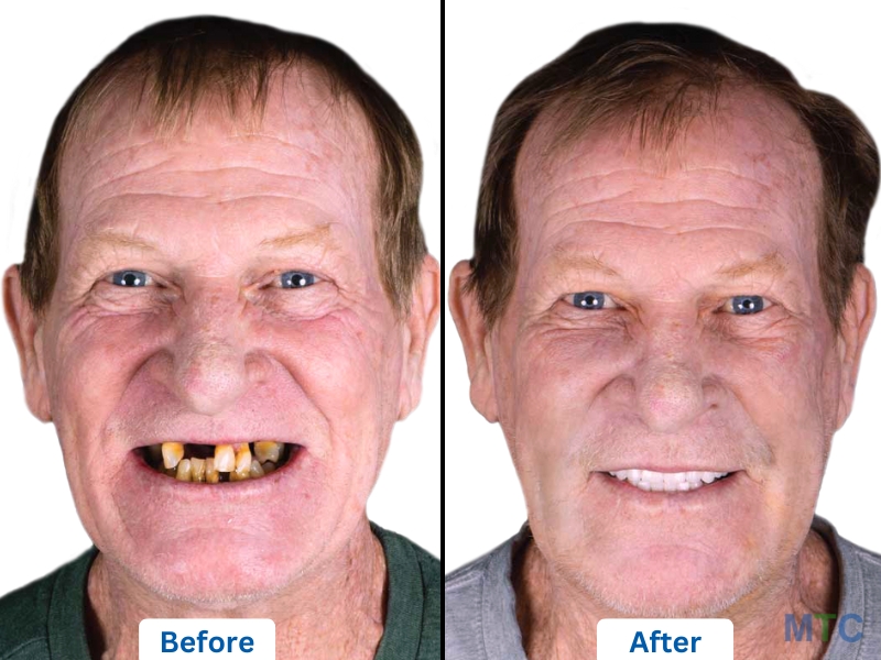 Affordable Full Mouth Dental Implants