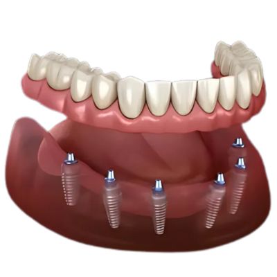 all on 6 dental implants