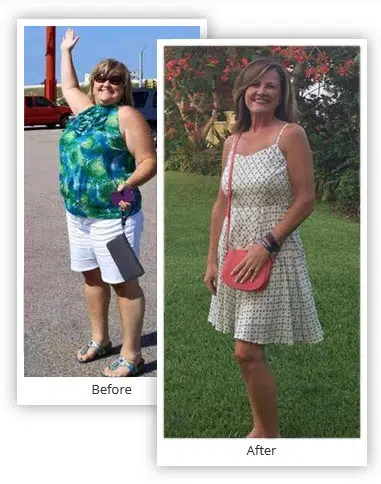 Before and After Bariatric Surgery in Mexico 