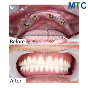 Dental work in Vietnam - Before & after 