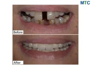 Before After Dental Implants in Izmir Turkey