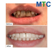 Before-After-Dental-Veneers-and-Crowns-in-Bucharest