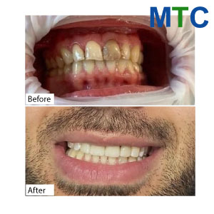 Before After-Front-Mouth-Restoration-in-Bucharest