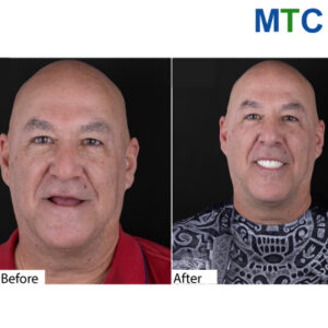 Full Mouth Implants, Mexico