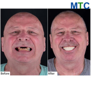 Full Arch Teeth Implants, Mexico