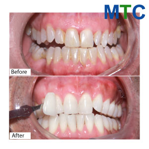 Before-After-teeth-whitening-in-Vietnam