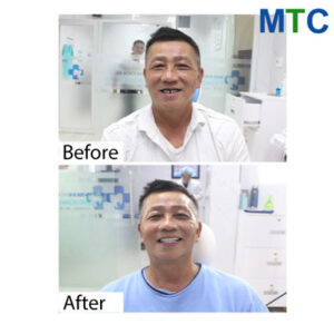 Dental work in Vietnam - Before & after 