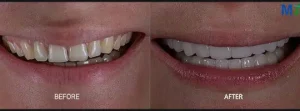 Dental Veneers – Before and After