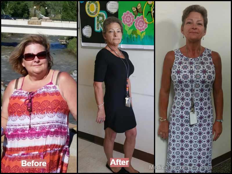 Before and After Bariatric Surgery in Mexico