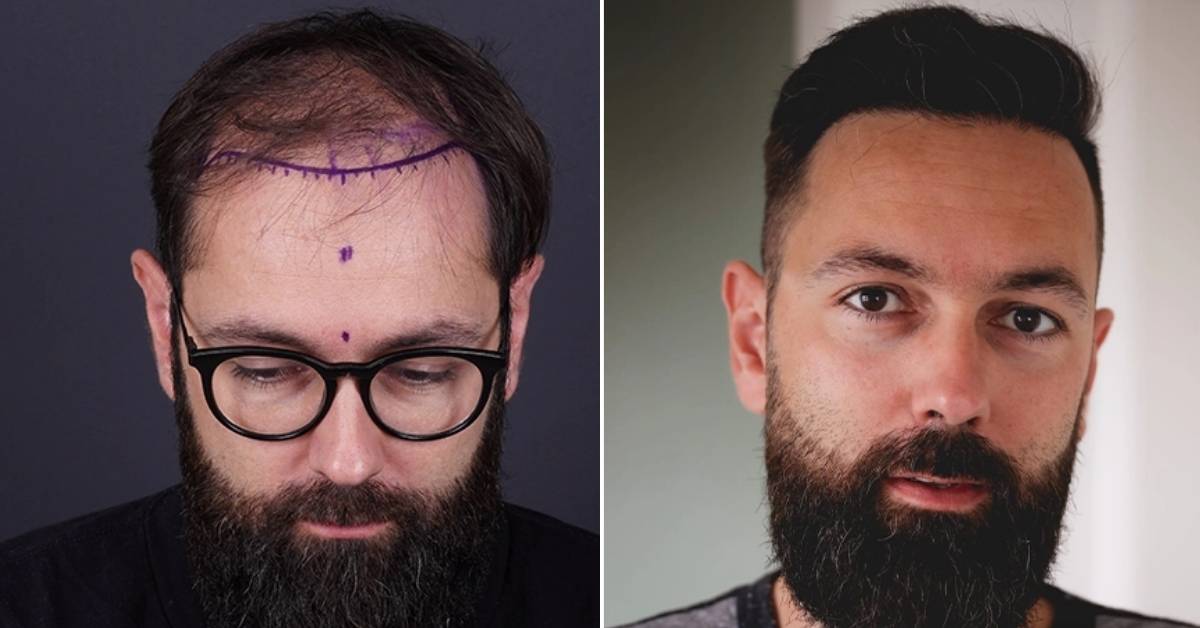 Best FUE Hair Transplant Turkey: Reclaim Your Hairline!