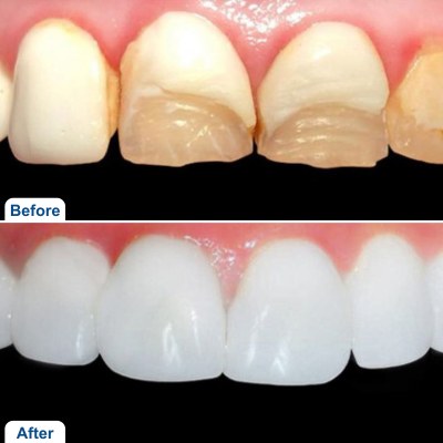 Before and after comparison of composite veneers. The top image shows chipped, worn, and discolored teeth, while the bottom image shows the teeth beautifully restored with smooth, white composite veneers for a natural and uniform look."