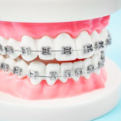 dental braces