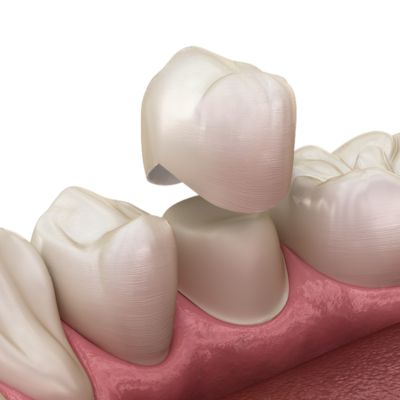 dental crowns