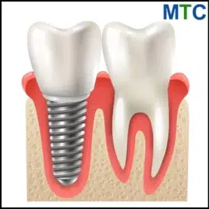 Titanium Dental Implant