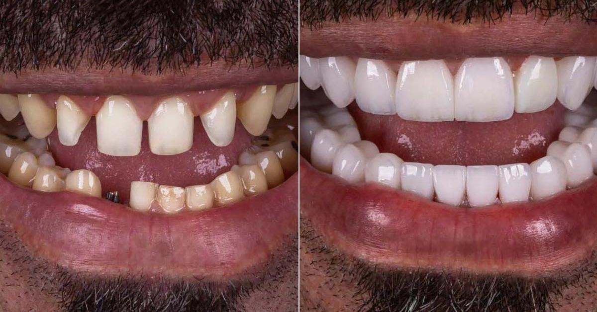 Dental Implants in Istanbul – Turkey