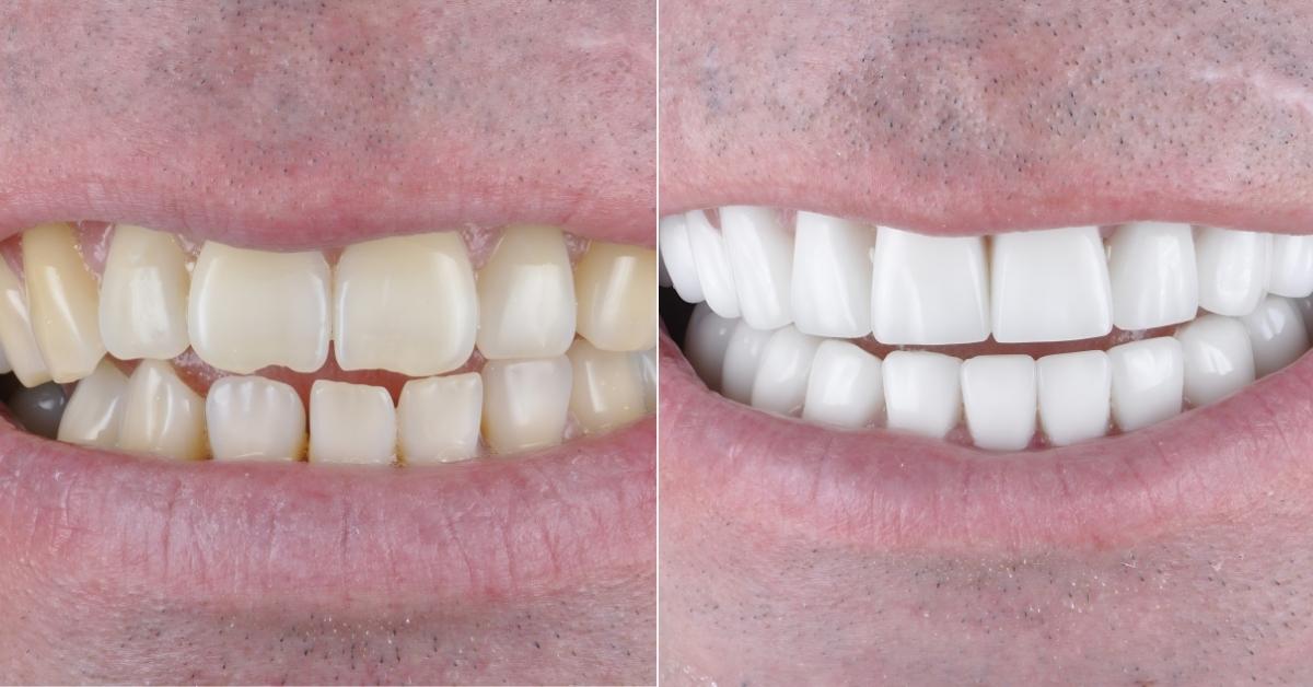 Dental Veneers in Izmir, Turkey